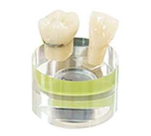 メタルセラミック