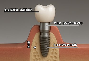 インプラント・土台・かぶせ物のイラスト